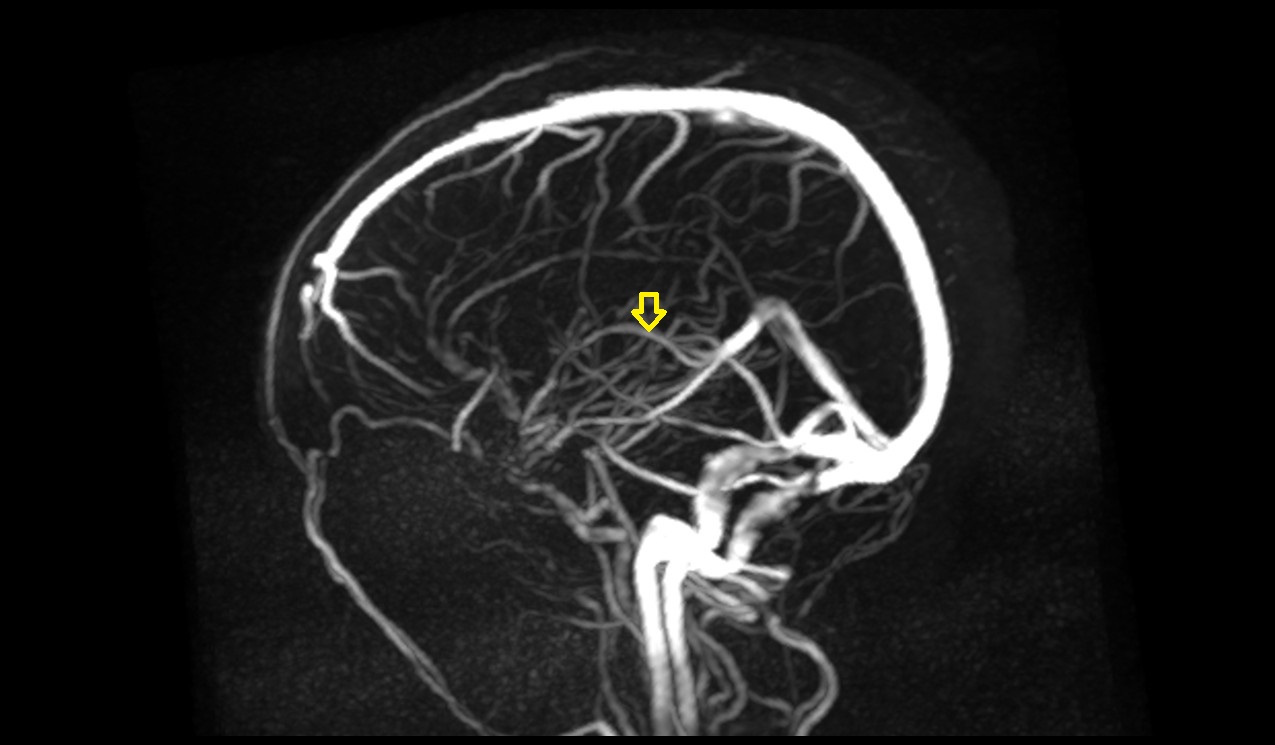 Internal cerebral veins MRI 3T mip image
