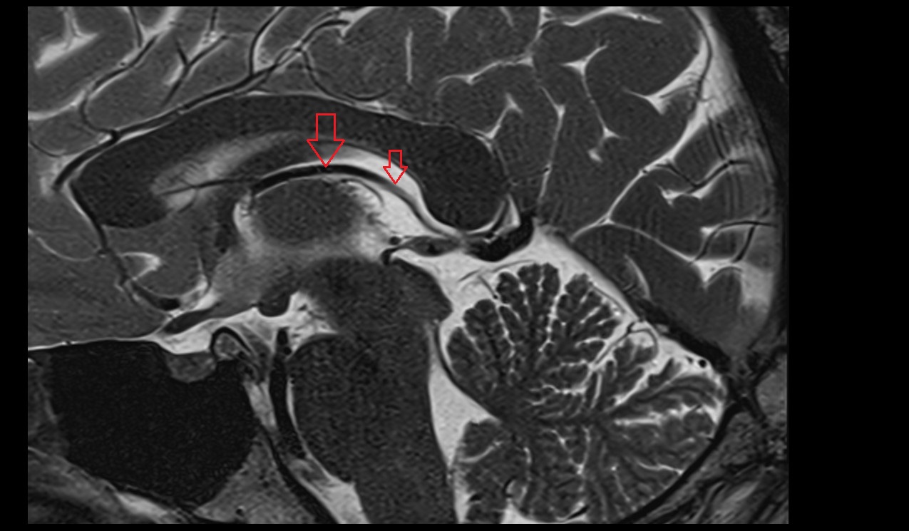 Internal cerebral veins MRI 3T sagittal image