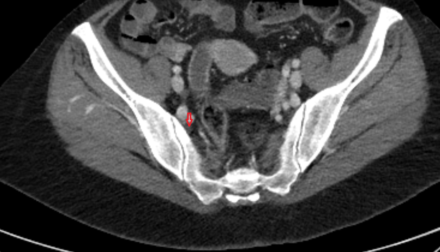 Internal iliac lymph nodes  CT axial  anatomy  image-img-00000-00000