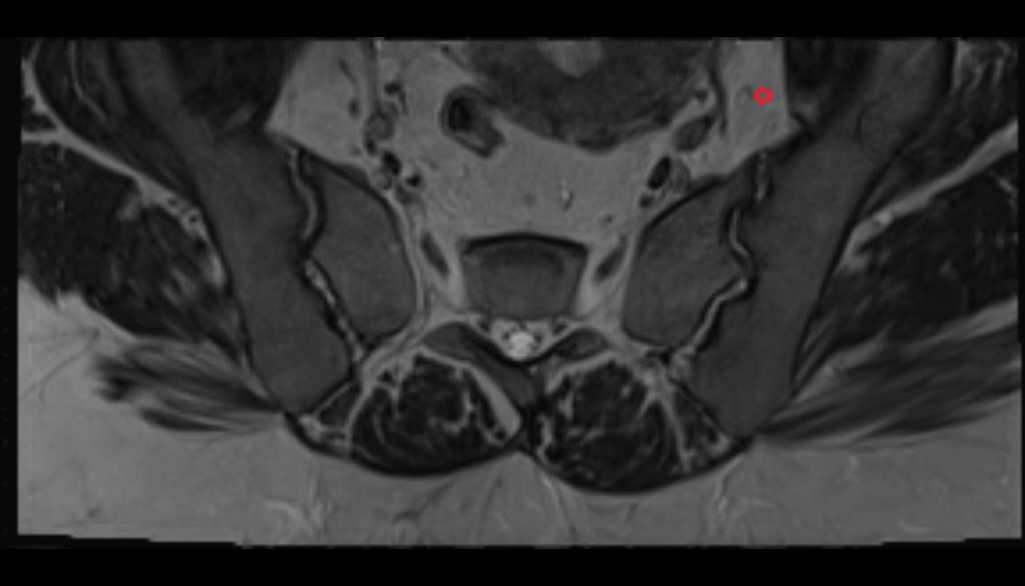 Internal iliac lymph nodes  CT axial  anatomy  image-img-00000-00000_00001
