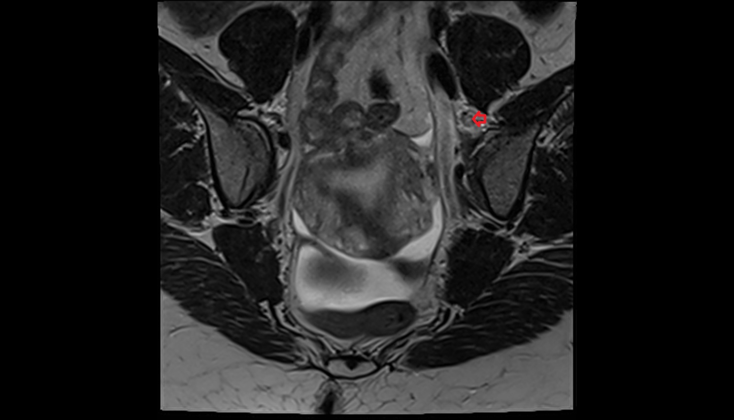 Internal iliac lymph nodes  mri coronal  anatomy  image-img-00000-00000