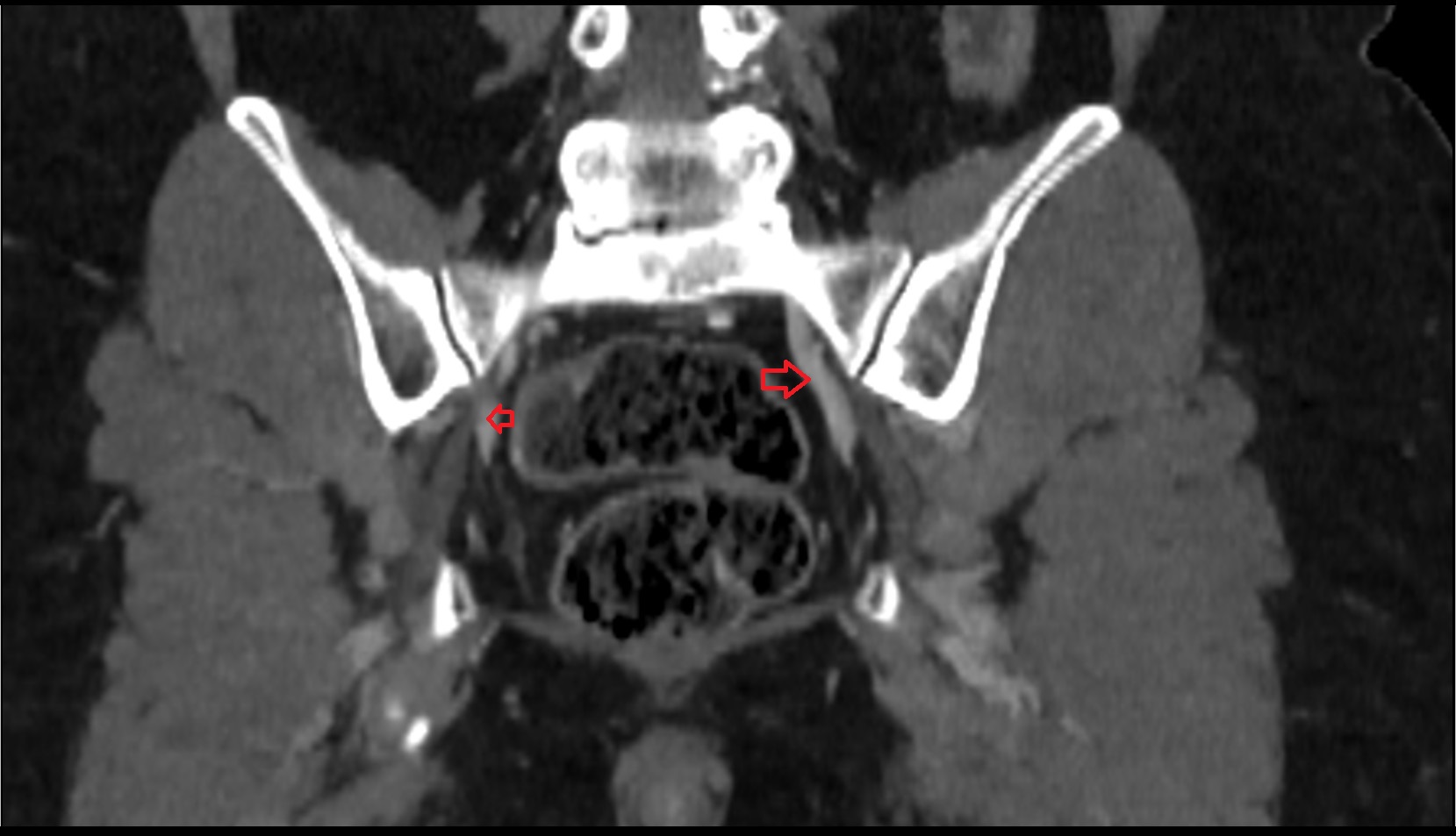 Internal iliac vein ct coronal