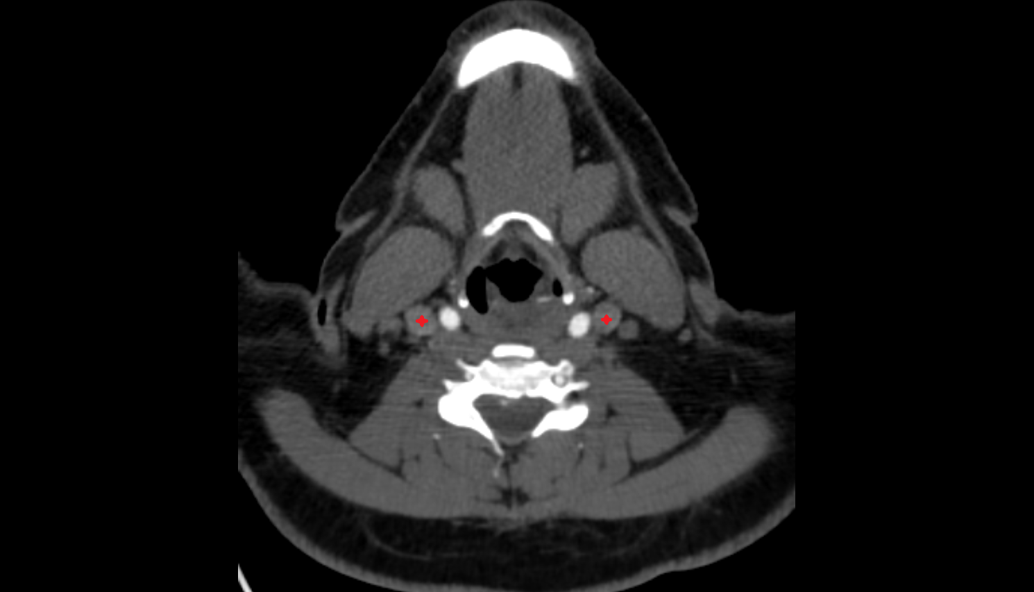 Internal jugular vein CT axial  image-img-00000-00000