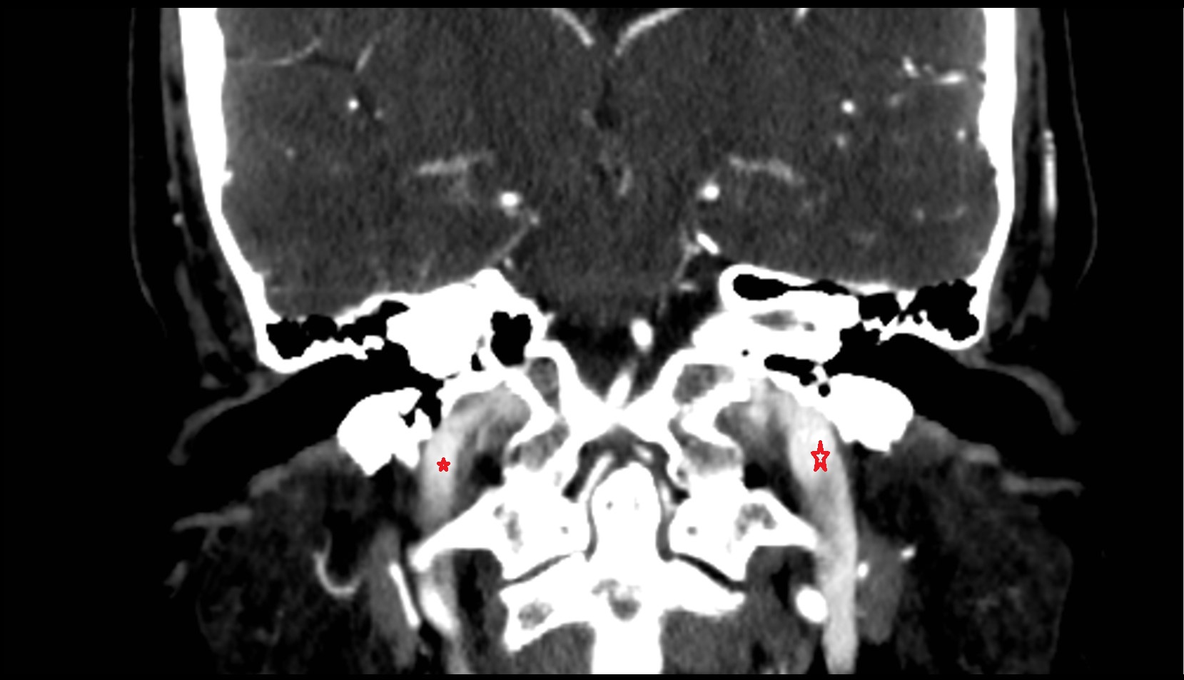 Internal jugular vein CT  image