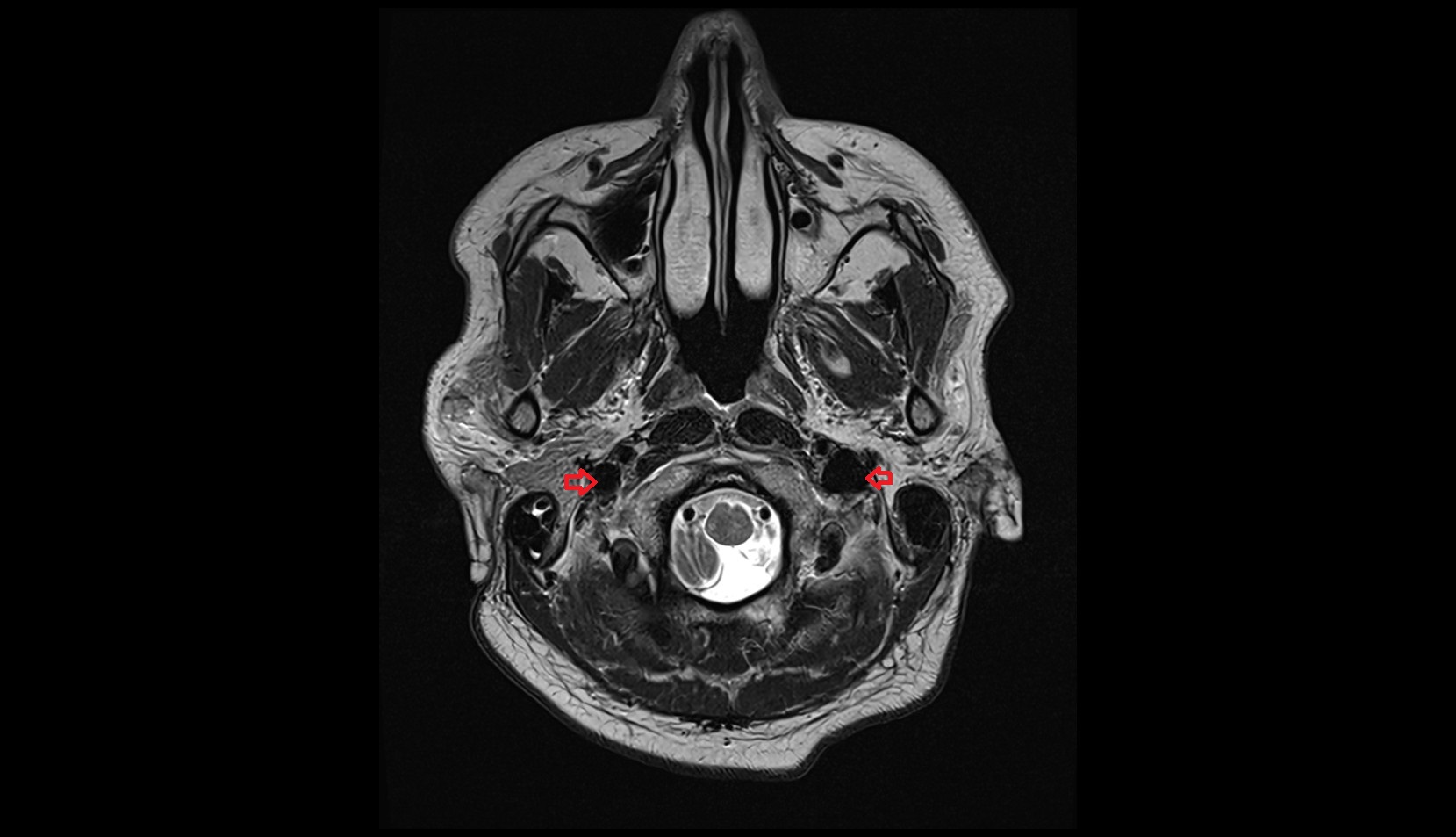 Internal jugular vein MRI 3T axial image