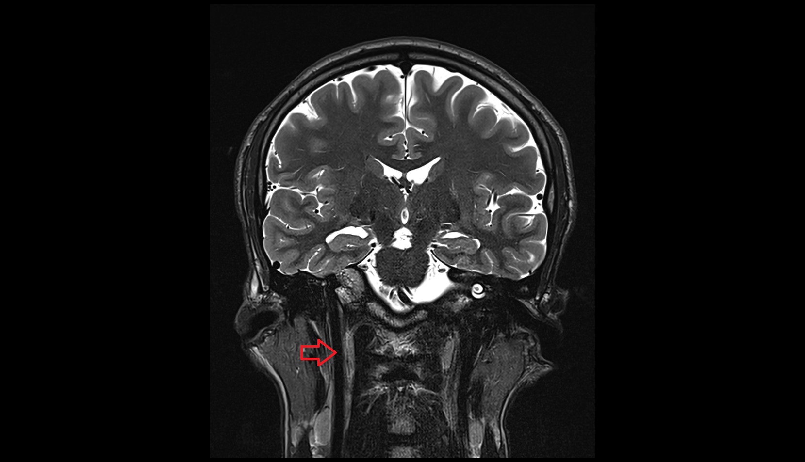 Internal jugular vein MRI 3T coronal image