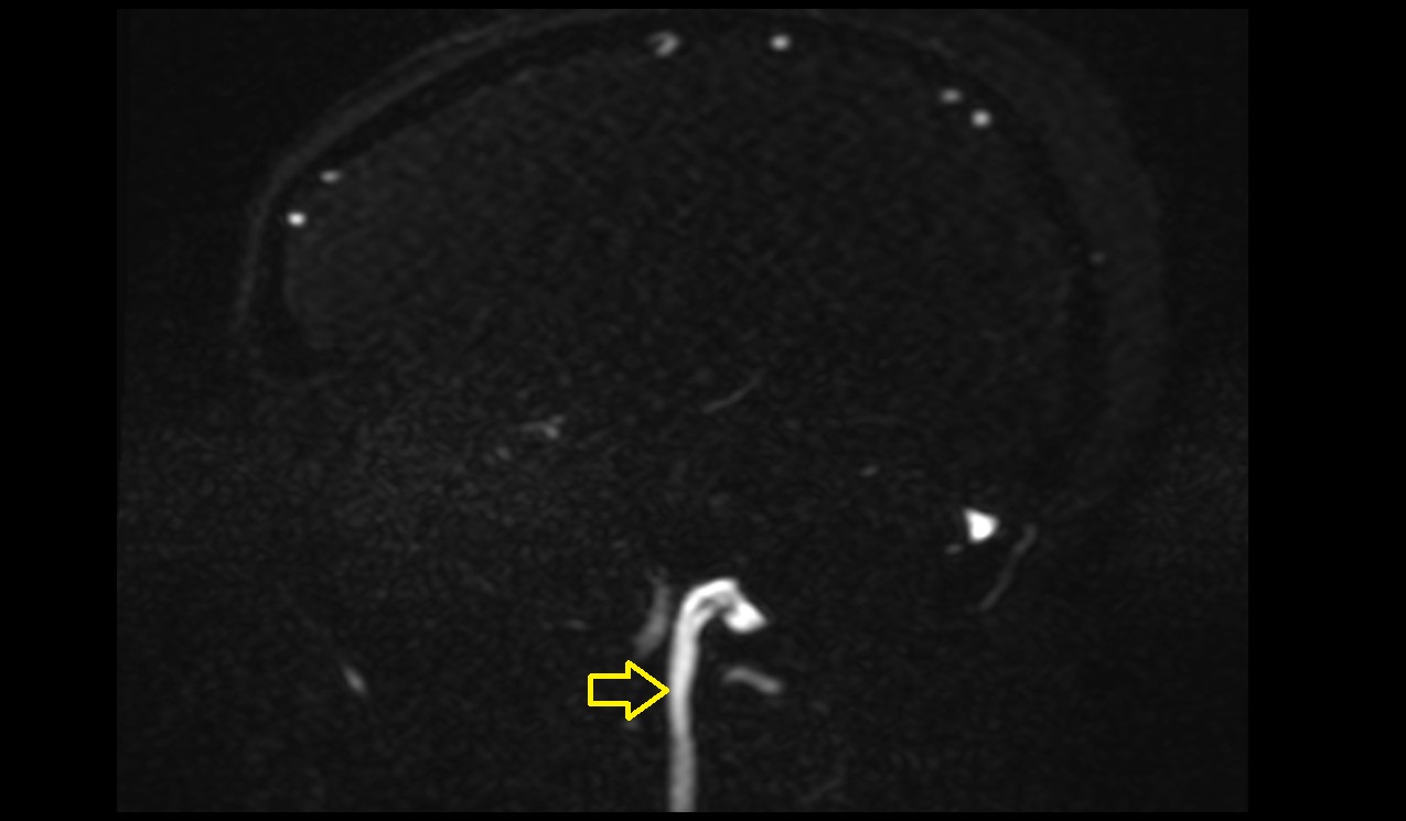 Internal jugular vein sagittal pc 3d image