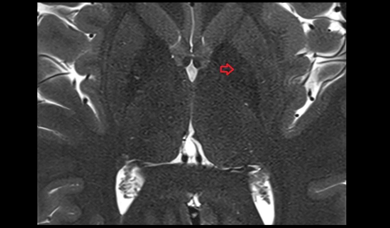 Internal medullary lamina mri 3t axial image