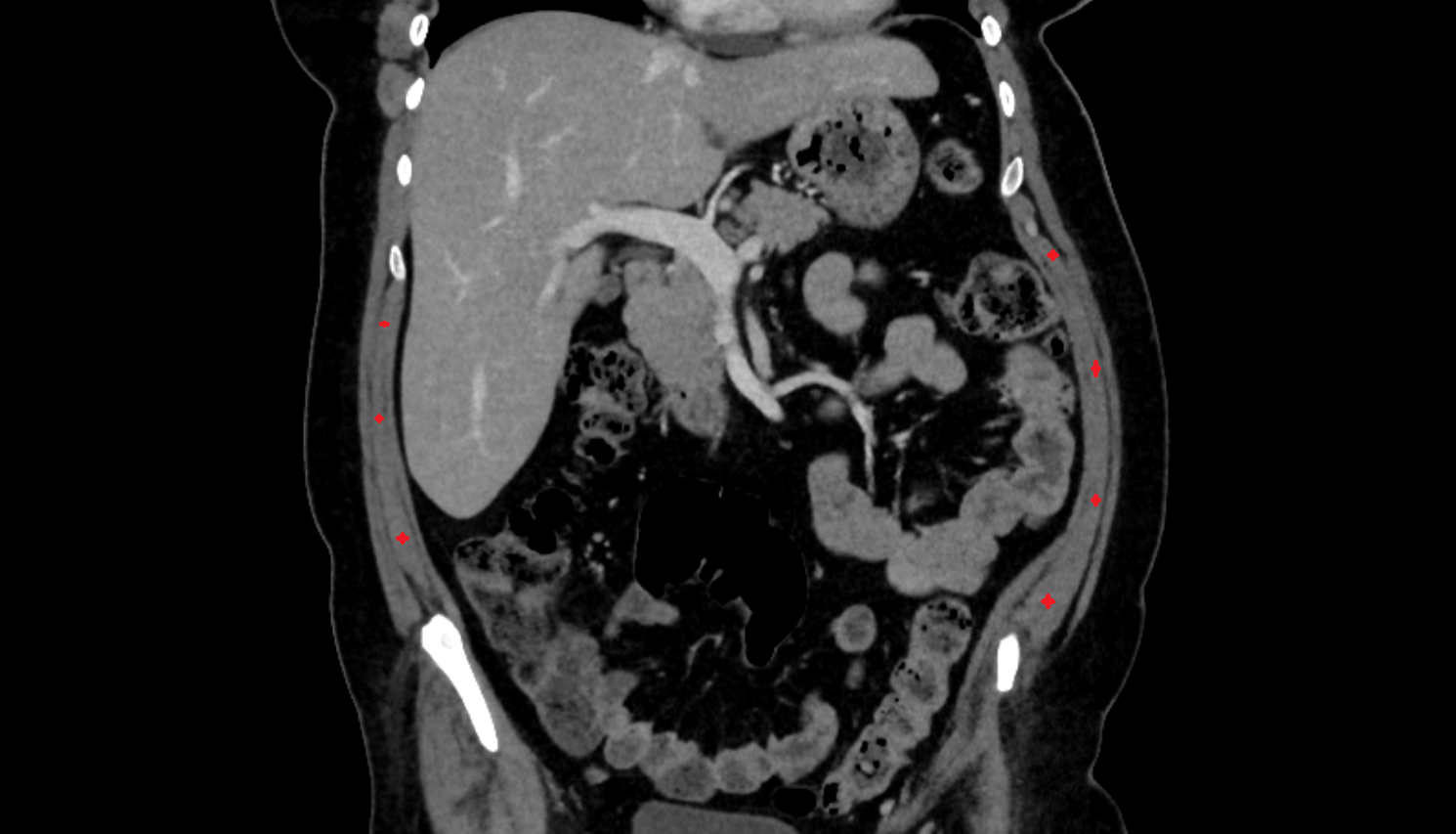 Internal oblique muscle CT  anatomy  Location and Imaging Appearance  -img-00000-00000
