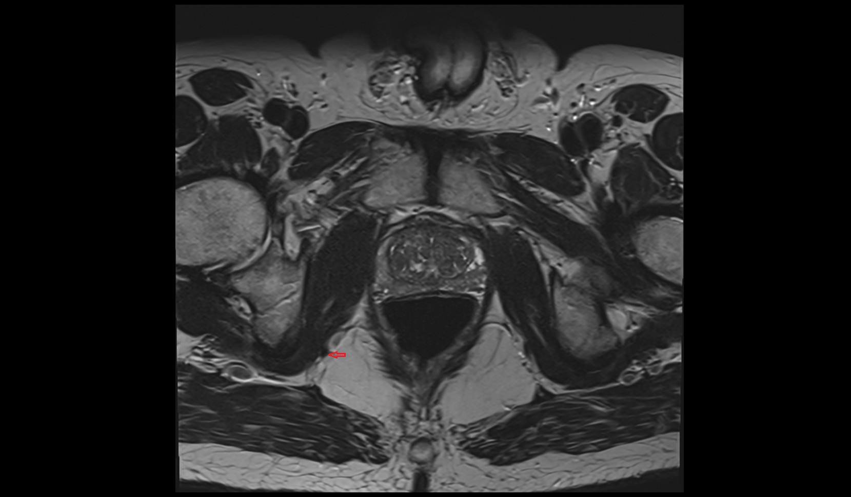 Internal pudendal artery