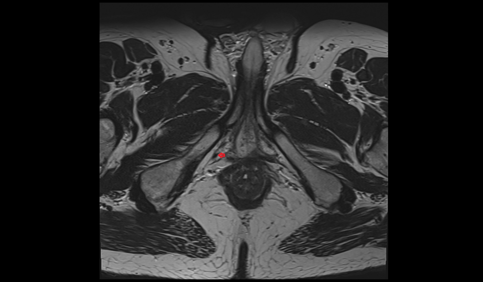 Internal pudendal artery male image 2