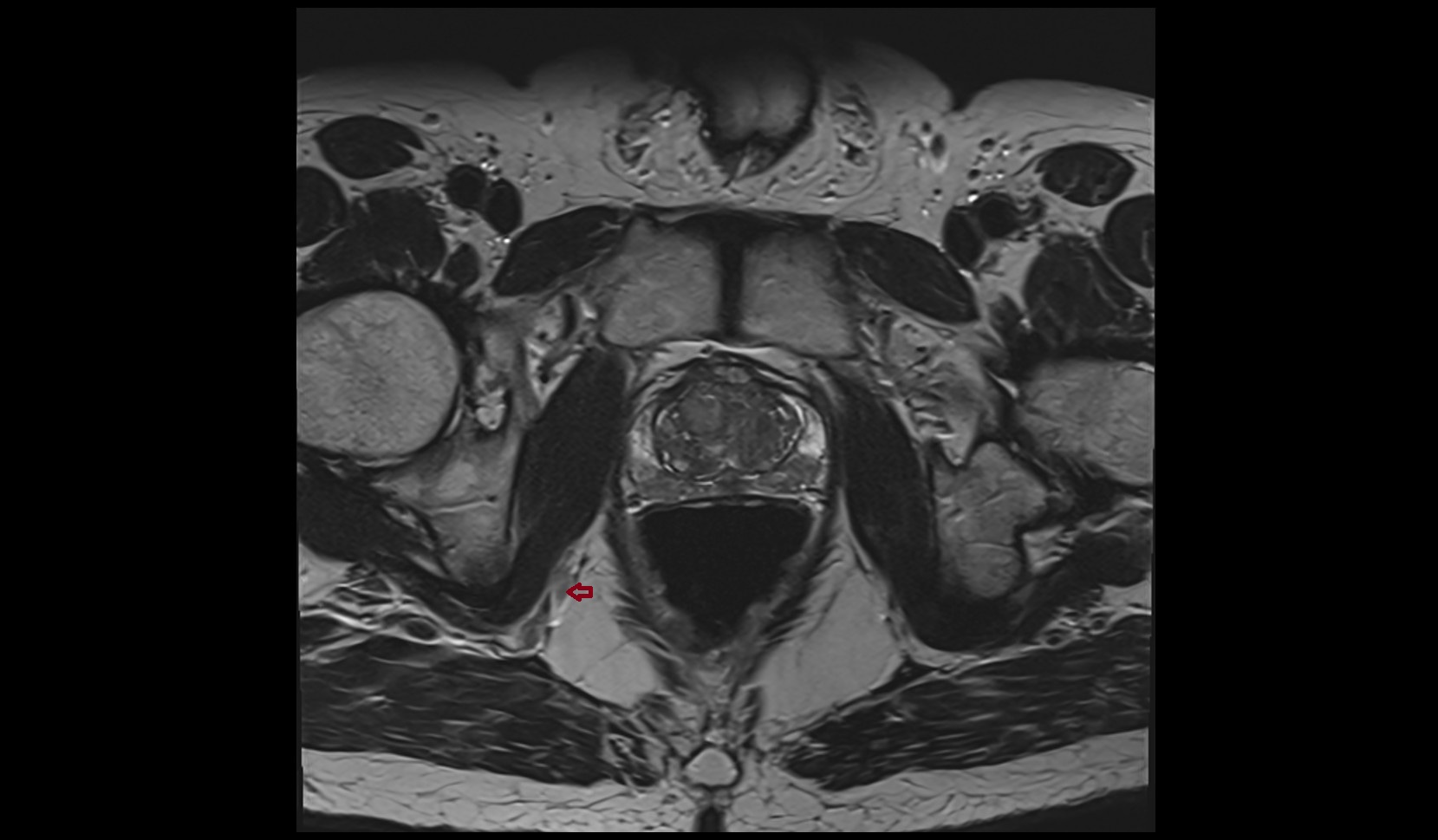 Internal pudendal vein male image 1