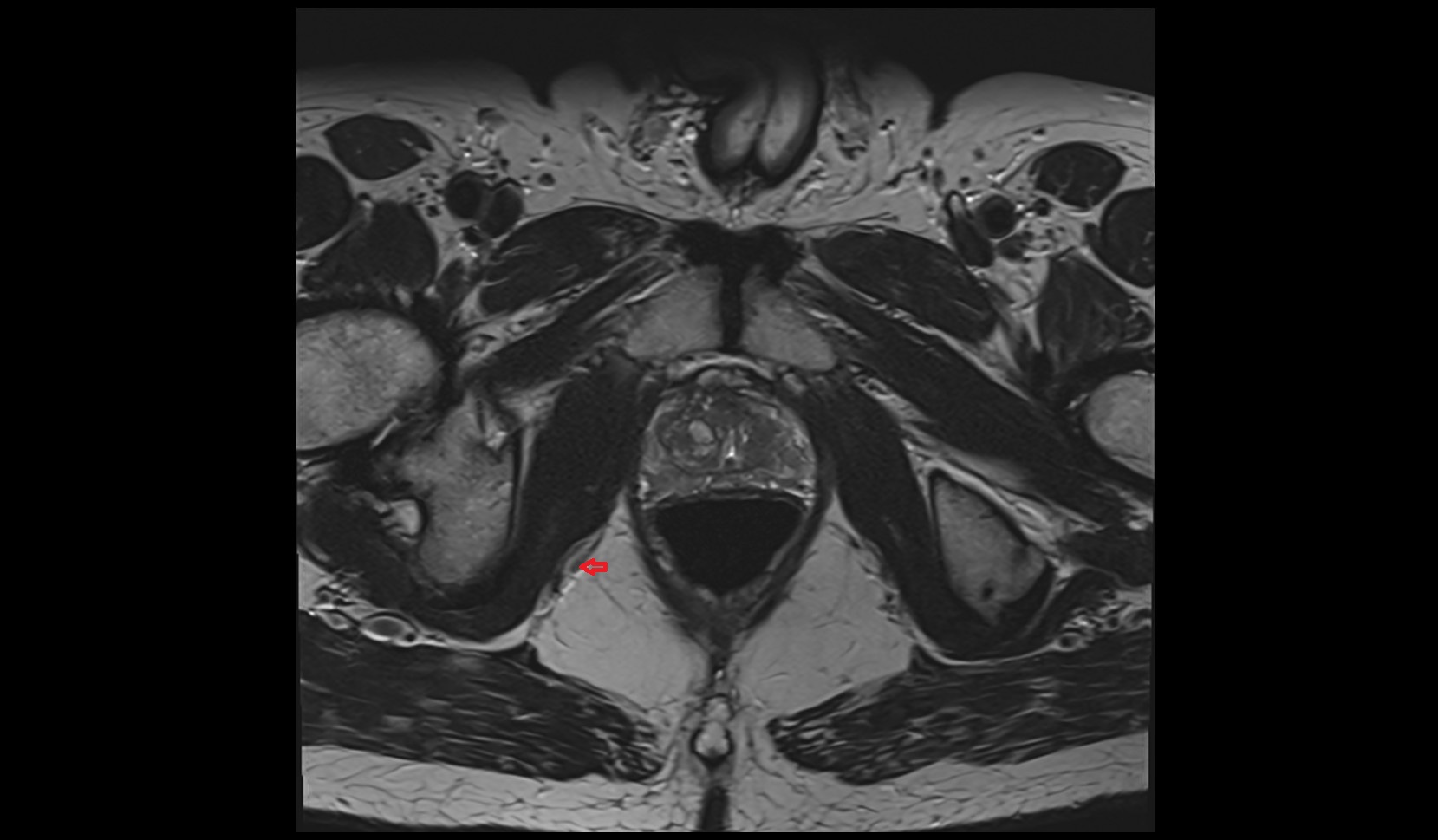 Internal pudendal vein male image 2