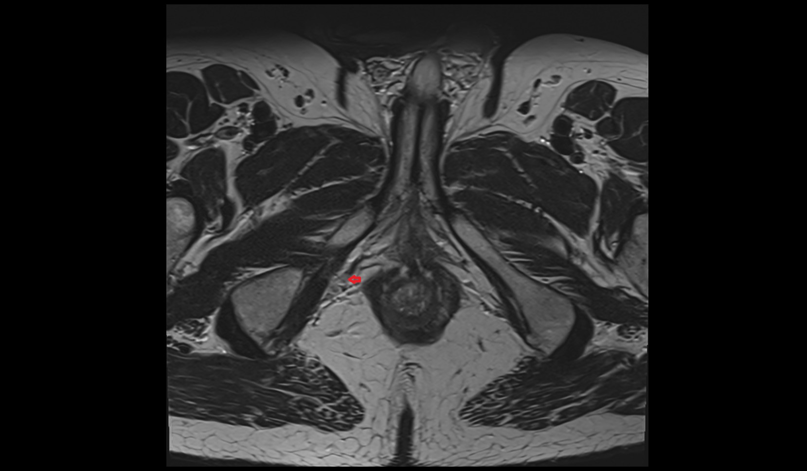 Internal pudendal vein male image 3