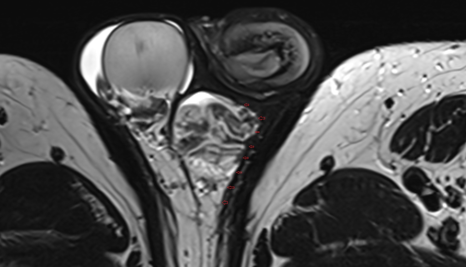 Internal spermatic fascia  mri axial  anatomy  image-img-00000-00000
