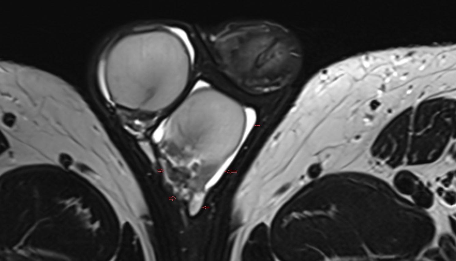 Internal spermatic fascia  mri axial  anatomy  image-img-00000-00000_00001