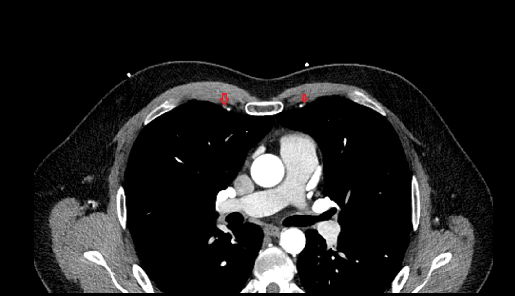 Internal thoracic veins CT axial image
