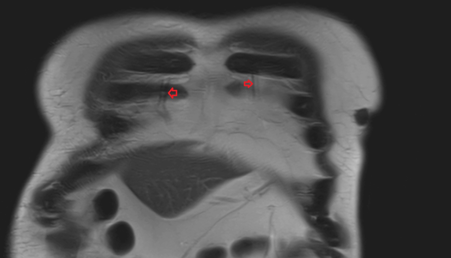 Internal thoracic veins  MRI coronal  anatomy  image -img-00000-00000