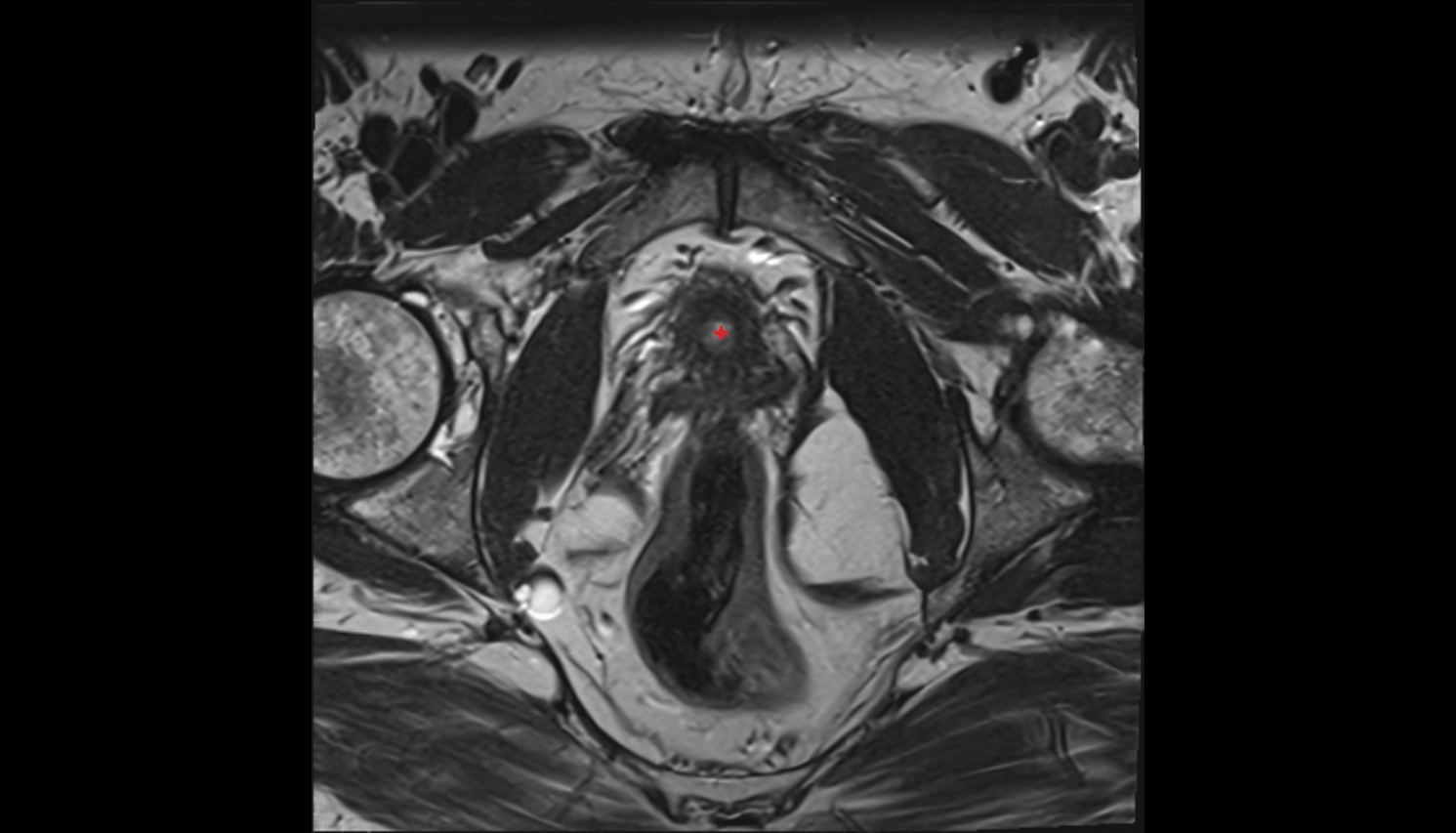 Internal urethral orifice  MRI axial  anatomy  image-img-00000-00000