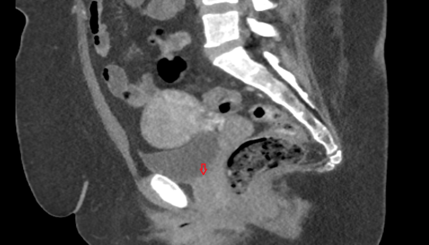 Internal urethral orifice  ct sagittal  anatomy  image-img-00000-00000