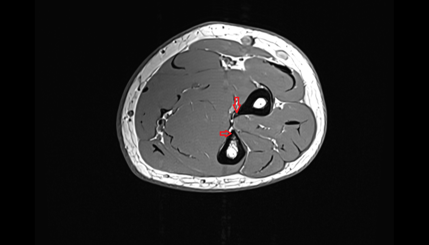 Interosseous border mri  anatomy labelled image-img-00000-00000