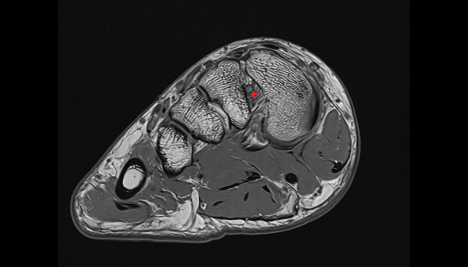 Interosseous cuneometatarsal Ligament (Lisfranc Proper Ligament) coronal cross sectional anatomy 3T MRI AI enhanced radiology image-img-00000-00000