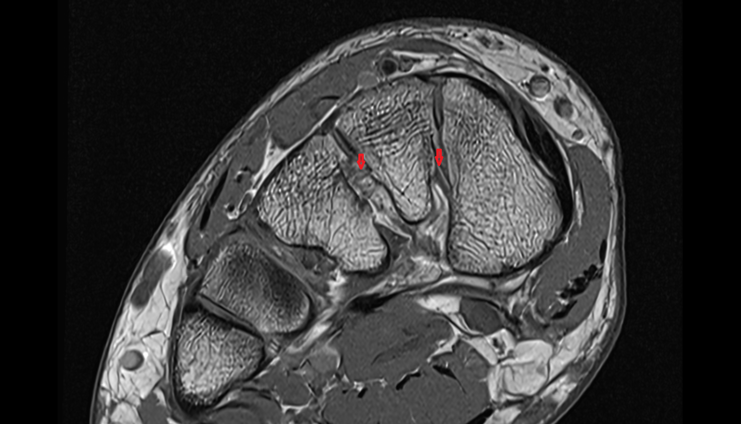 Interosseous intercuneiform ligaments axial cross sectional anatomy 3T MRI AI enhanced radiology image-img-00000-00000