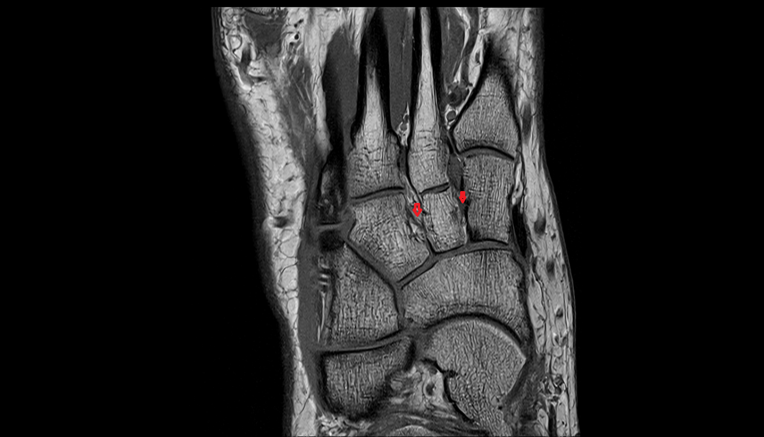 Interosseous intercuneiform ligaments  coronal cross sectional anatomy 3T MRI AI enhanced radiology image-img-00000-00000