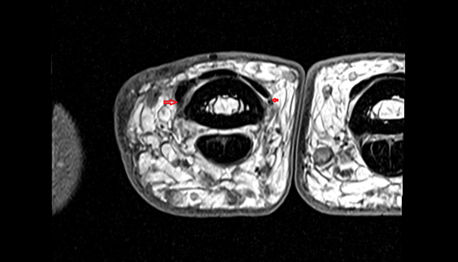 Interosseous lateral band hand  MRI axial  image-img-00000-00000