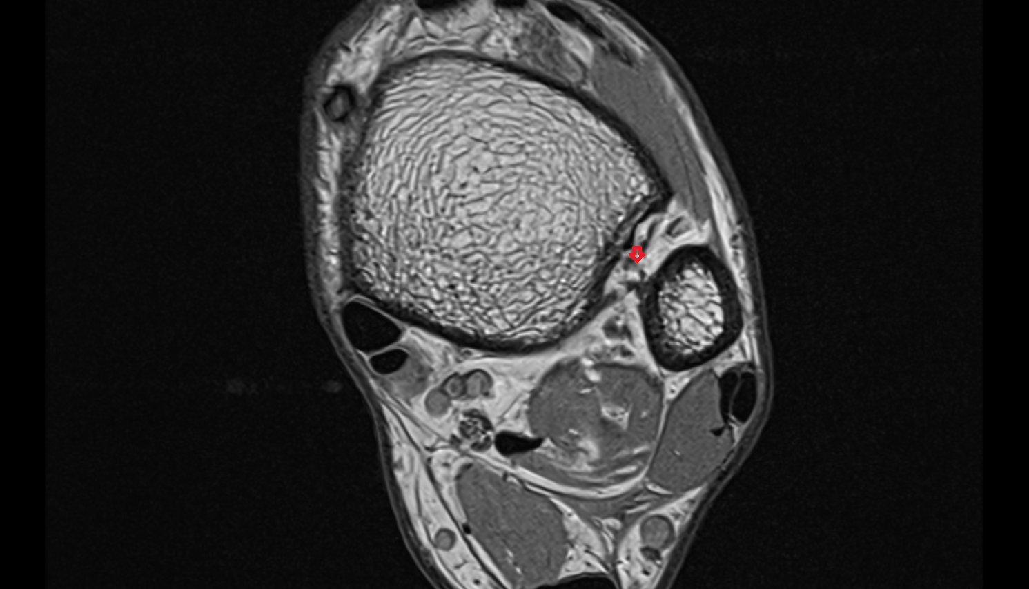 Interosseous membrane (middle tibiofibular ligament) Axial cross sectional anatomy 3T MRI AI enhanced radiology image-img-00000-00000