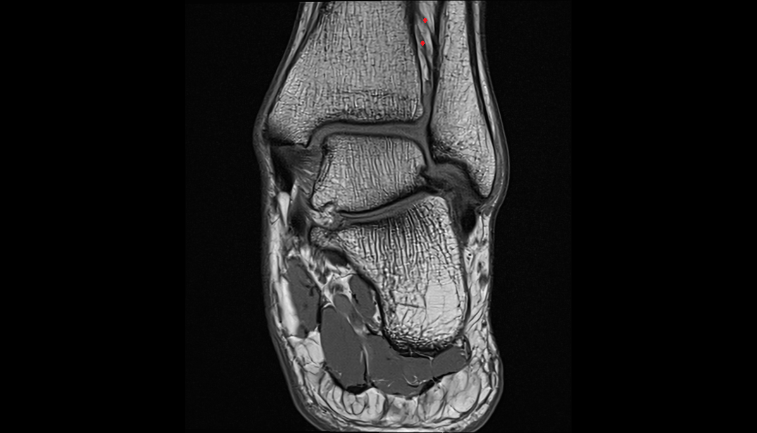 Interosseous membrane (middle tibiofibular ligament) Axial cross sectional anatomy 3T MRI AI enhanced radiology image-img-00000-00000_00001