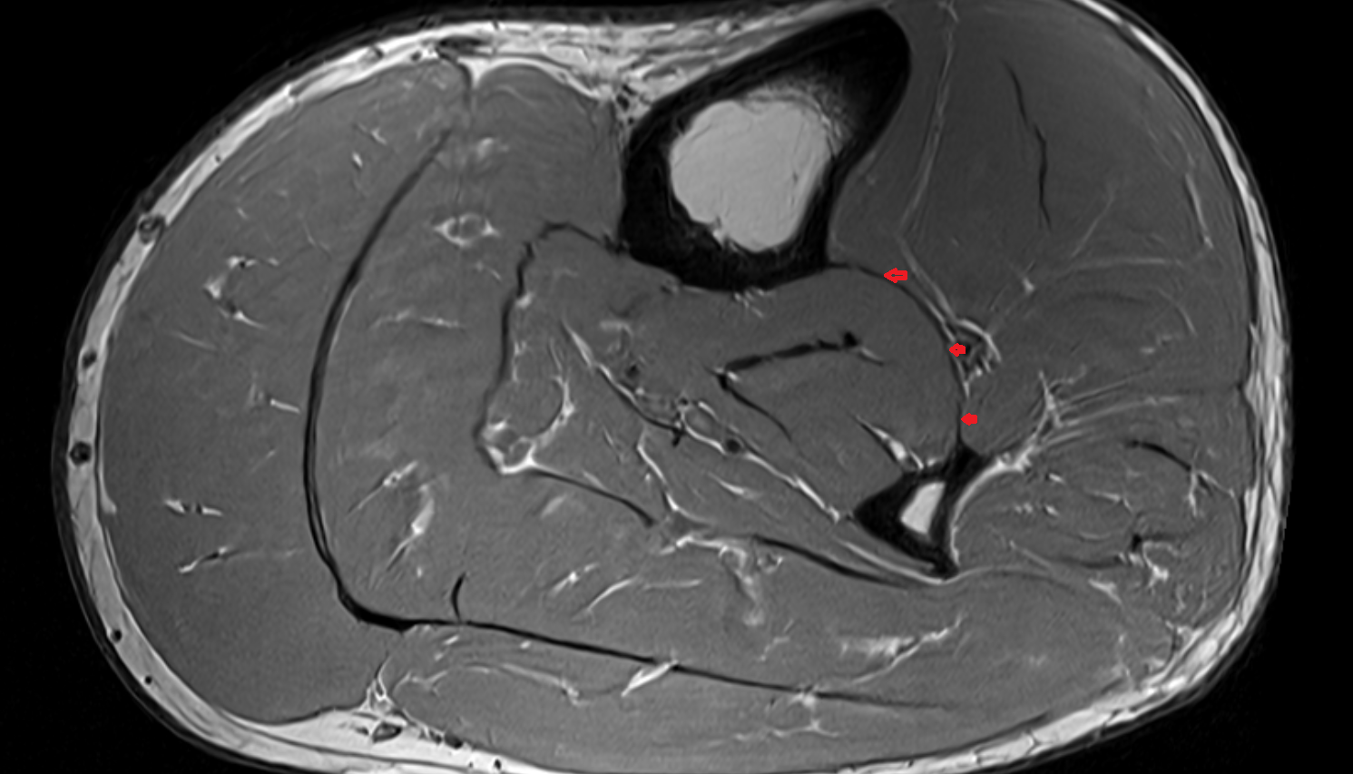 Interosseous membrane of leg  axial cross sectional anatomy 3T MRI AI enhanced radiology image-img-00000-00000