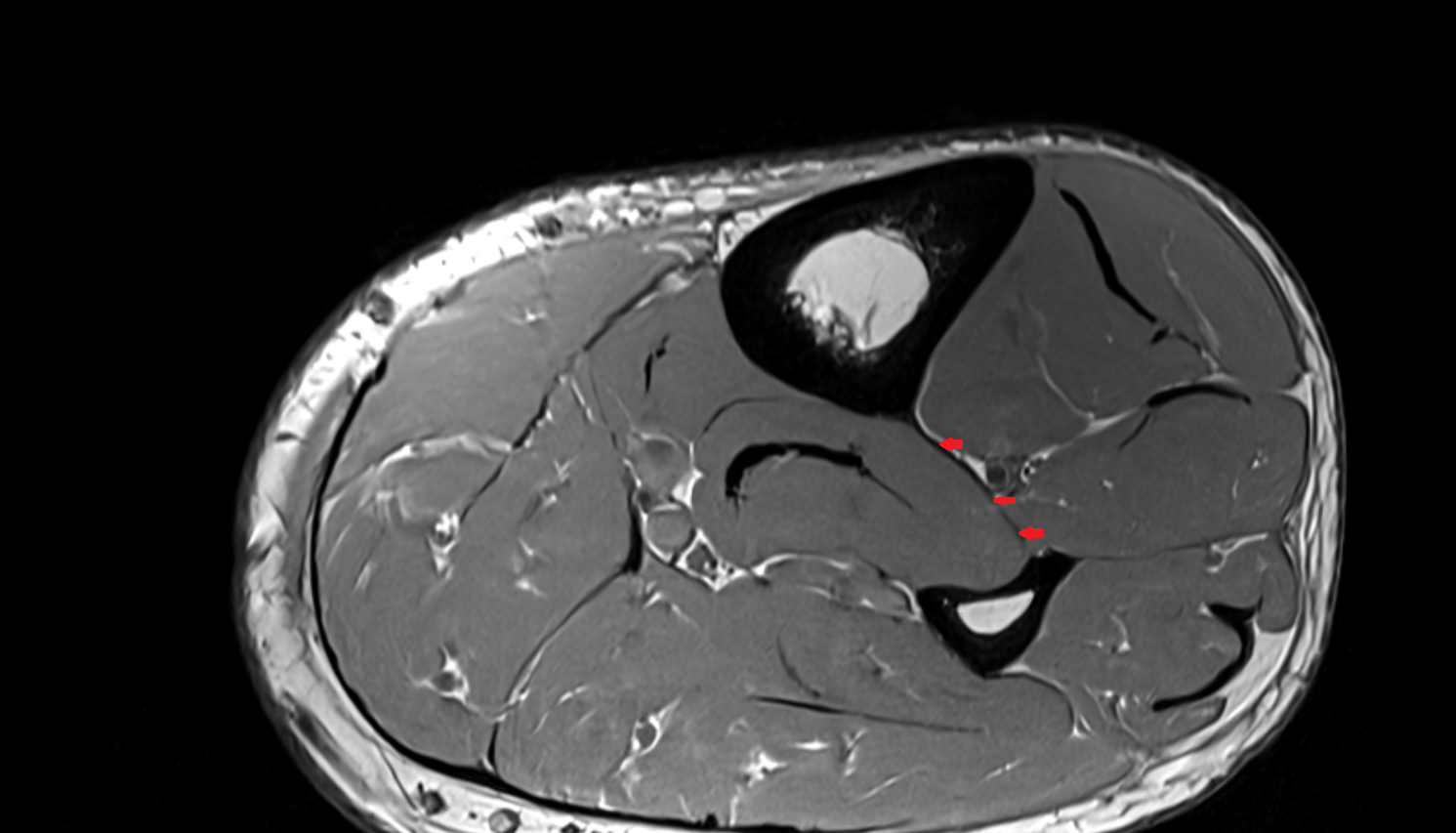 Interosseous membrane of leg  axial cross sectional anatomy 3T MRI AI enhanced radiology image-img-00000-00000_00001