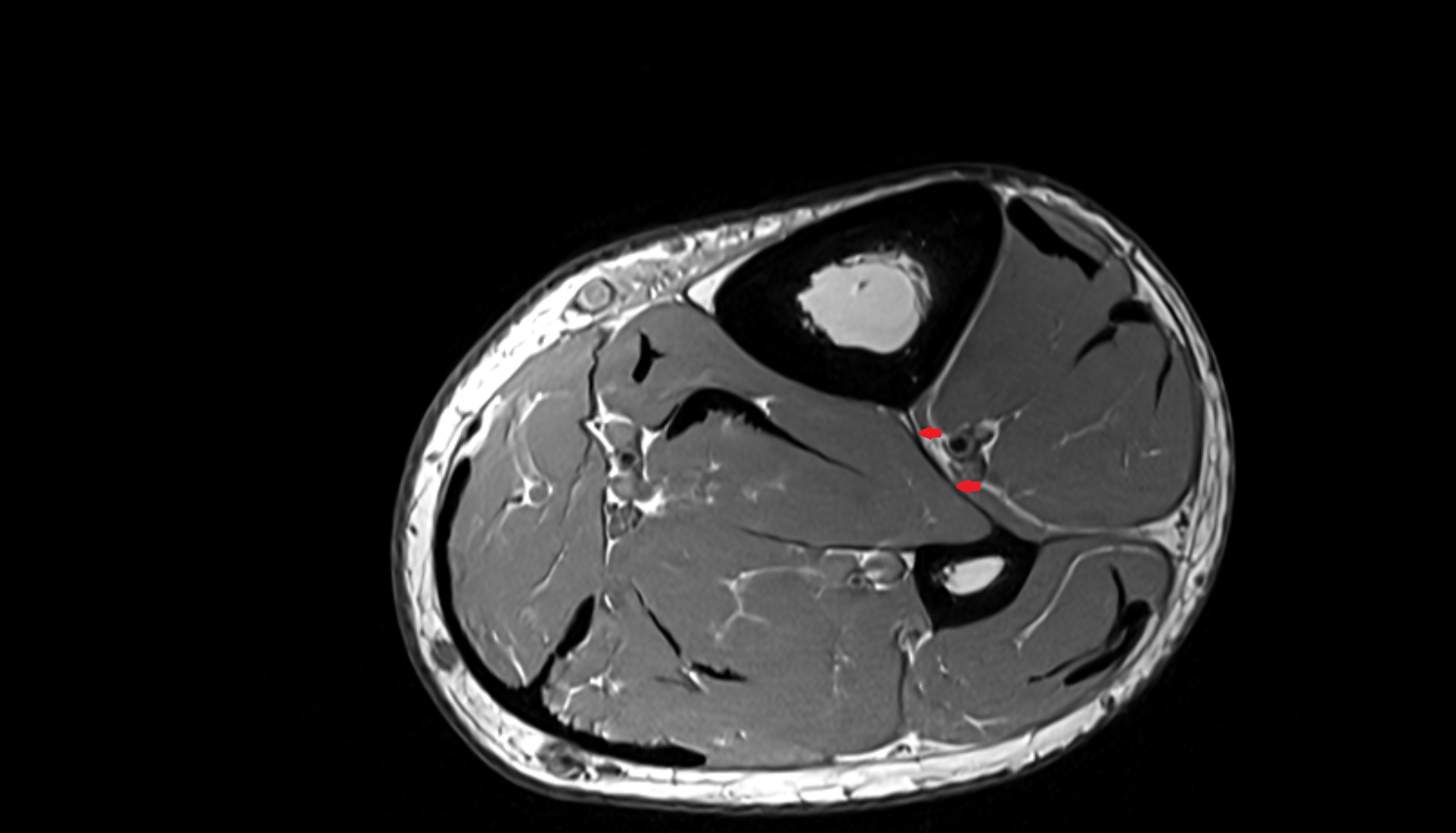 Interosseous membrane of leg  axial cross sectional anatomy 3T MRI AI enhanced radiology image-img-00000-00000_00002