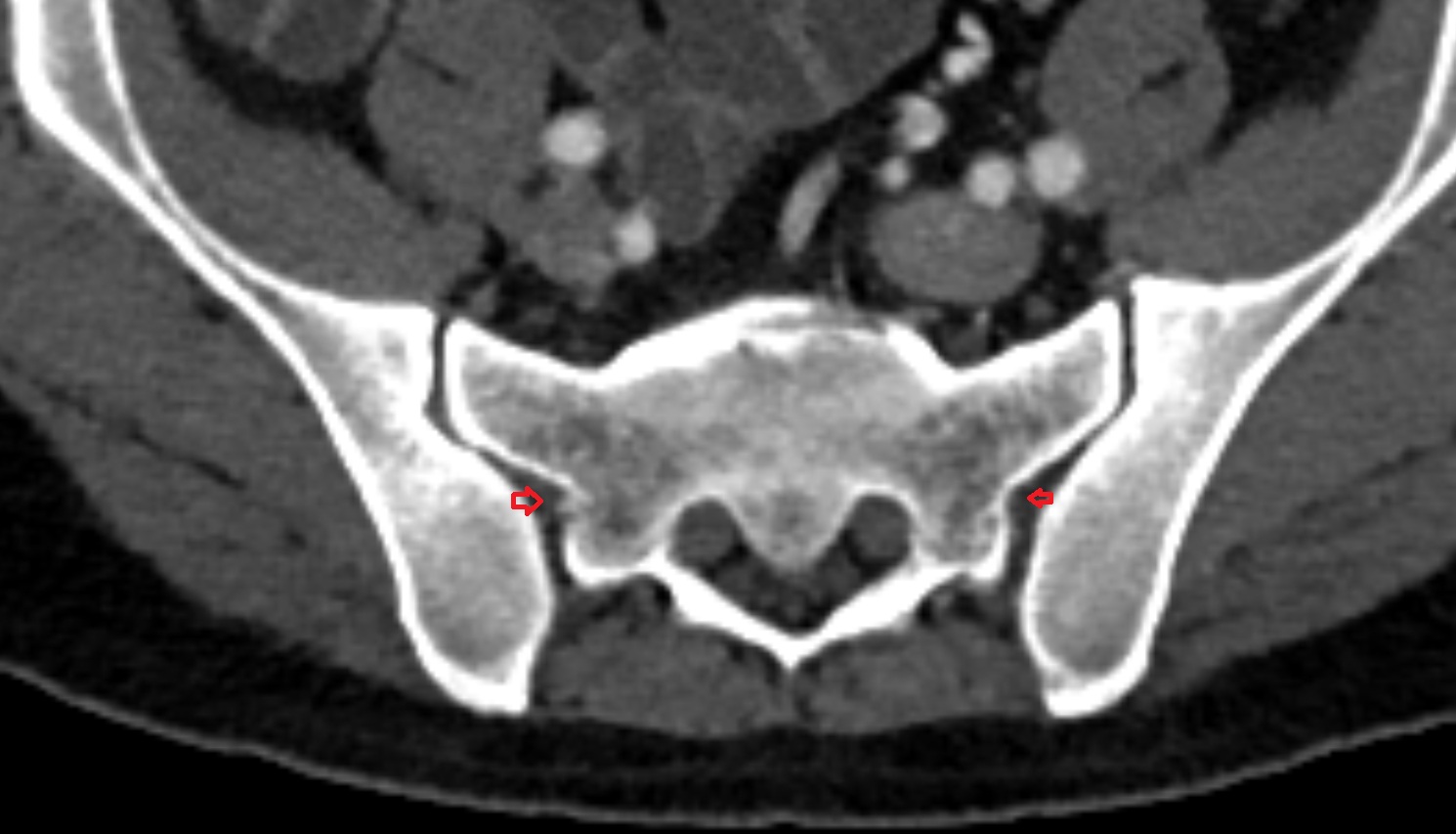 Interosseous sacroiliac ligament ct axial image