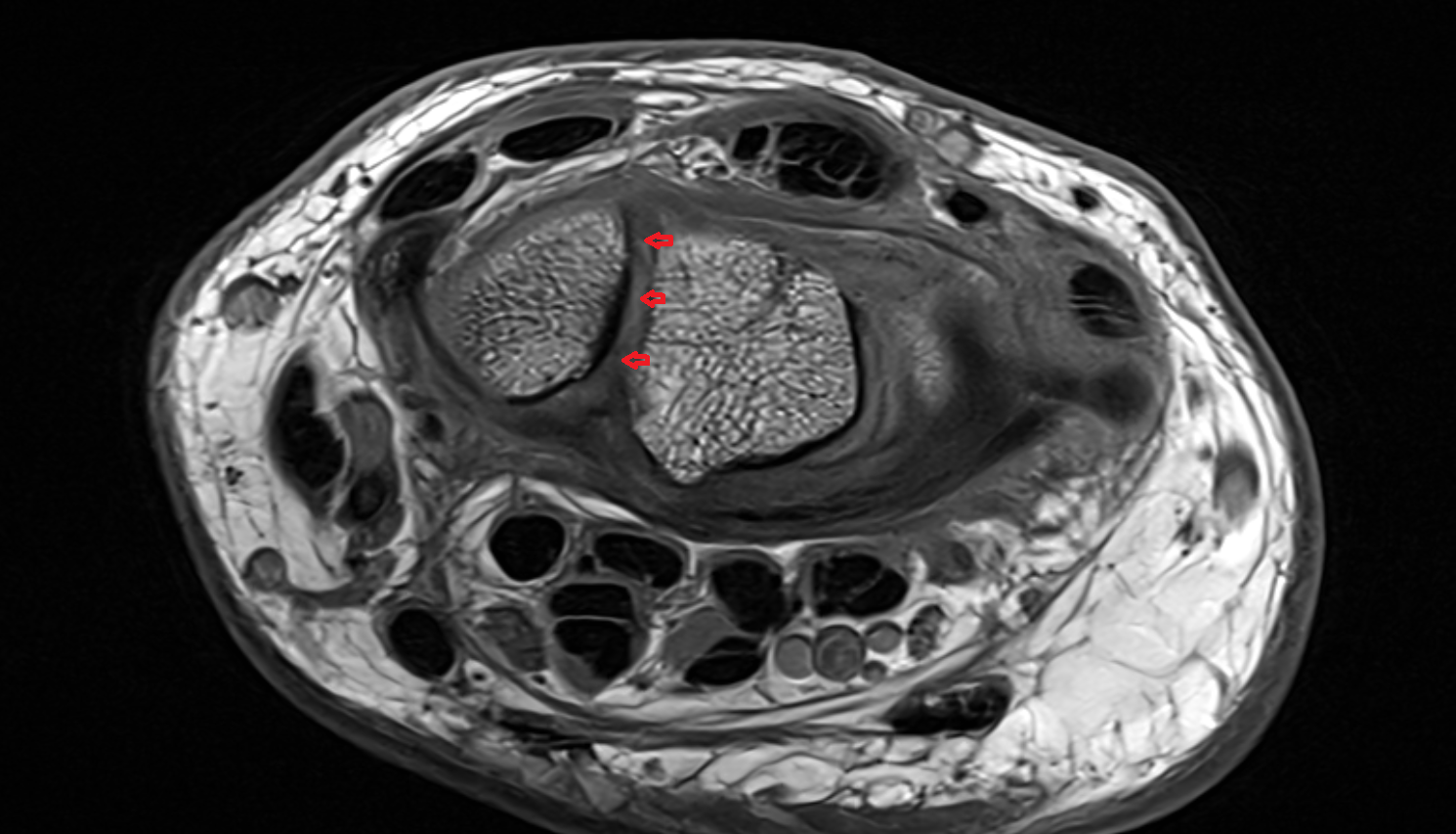 Interosseous scapholunate ligament axial cross sectional anatomy 3T MRI AI enhanced radiology image-img-00000-00000