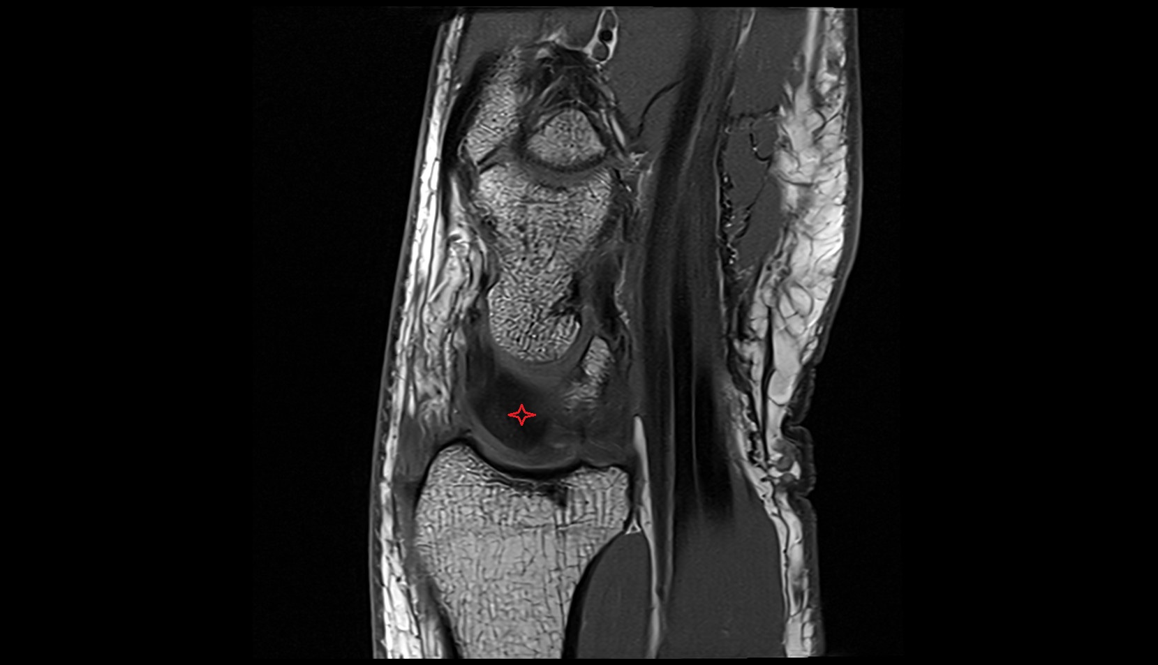 Interosseous scapholunate ligament sagittal mri image