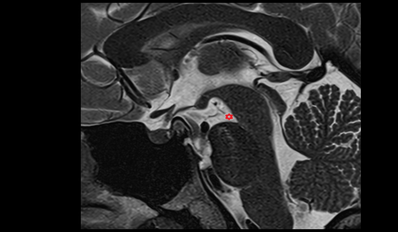 Interpeduncular cistern mri 3t sagittal image
