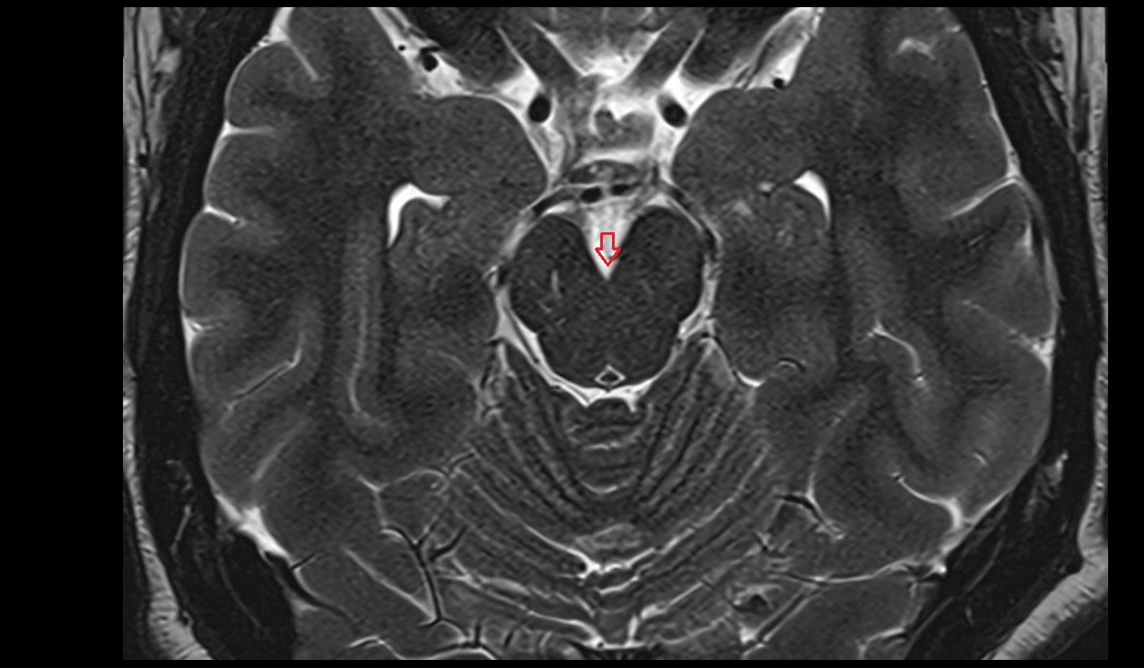 Interpeduncular fossa mri 3t axial image