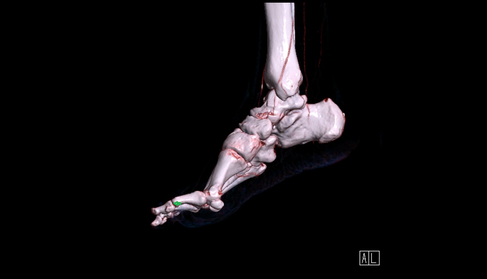 Interphalangeal joint of great toe 3d image