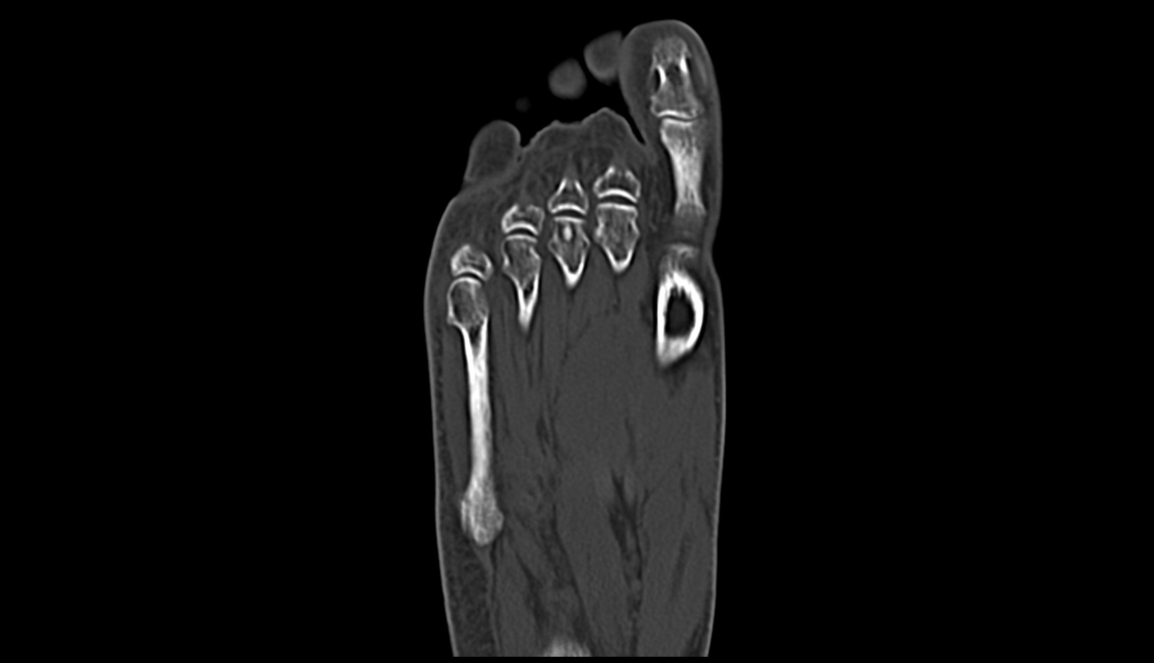 Interphalangeal joint of great toe ct coronal image