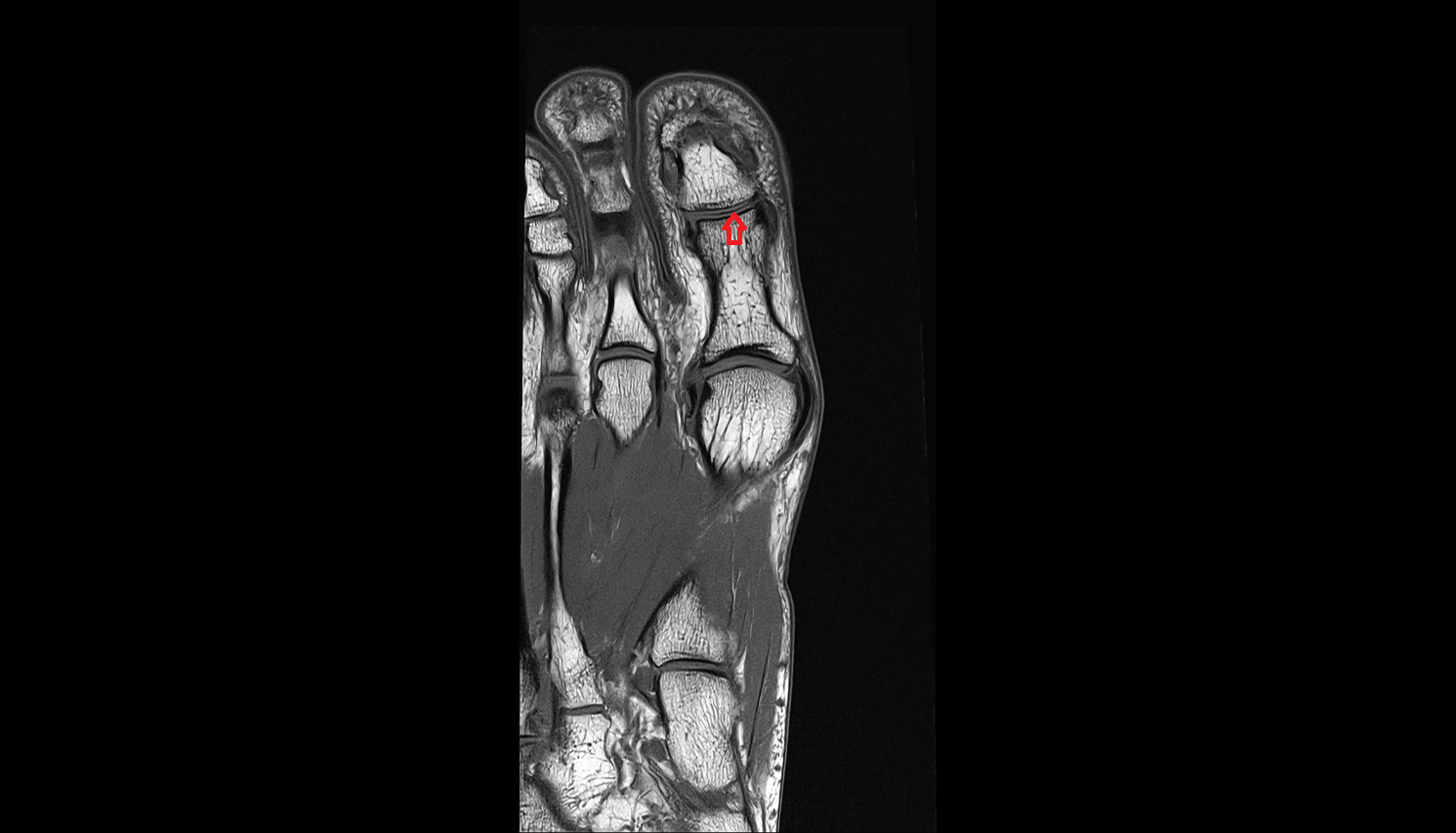 Interphalangeal joint of great toe  of foot coronal cross sectional anatomy 3T MRI AI enhanced radiology image-img-00000-00000