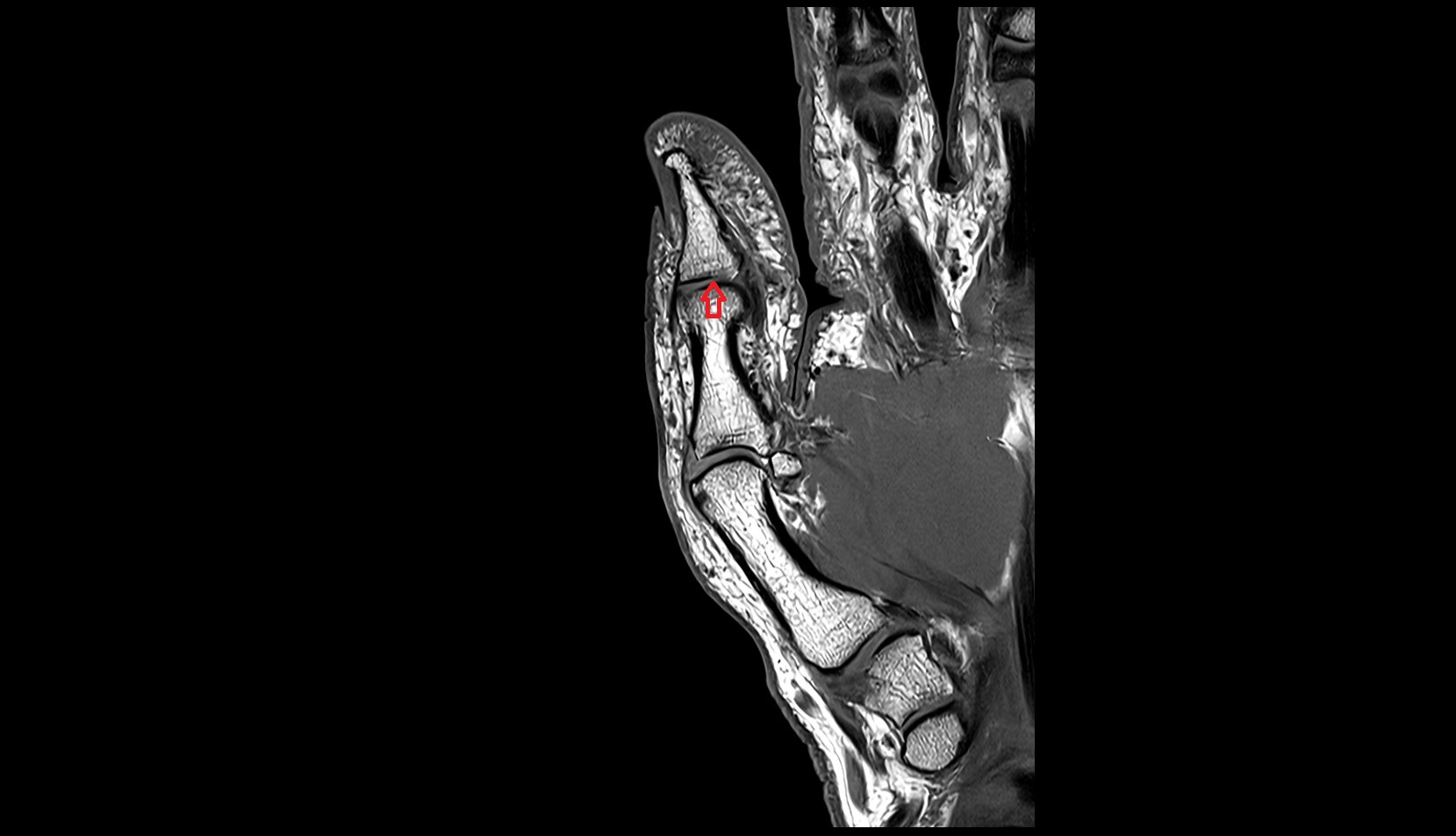 Interphalangeal joint of thumb mri image