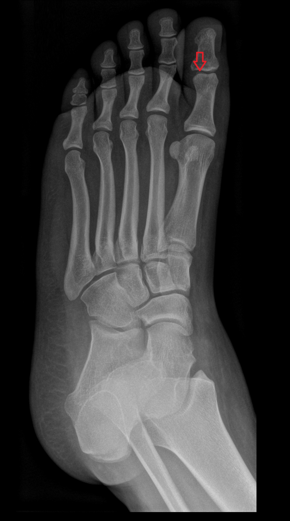 Interphalangeal sesamoid of great toe