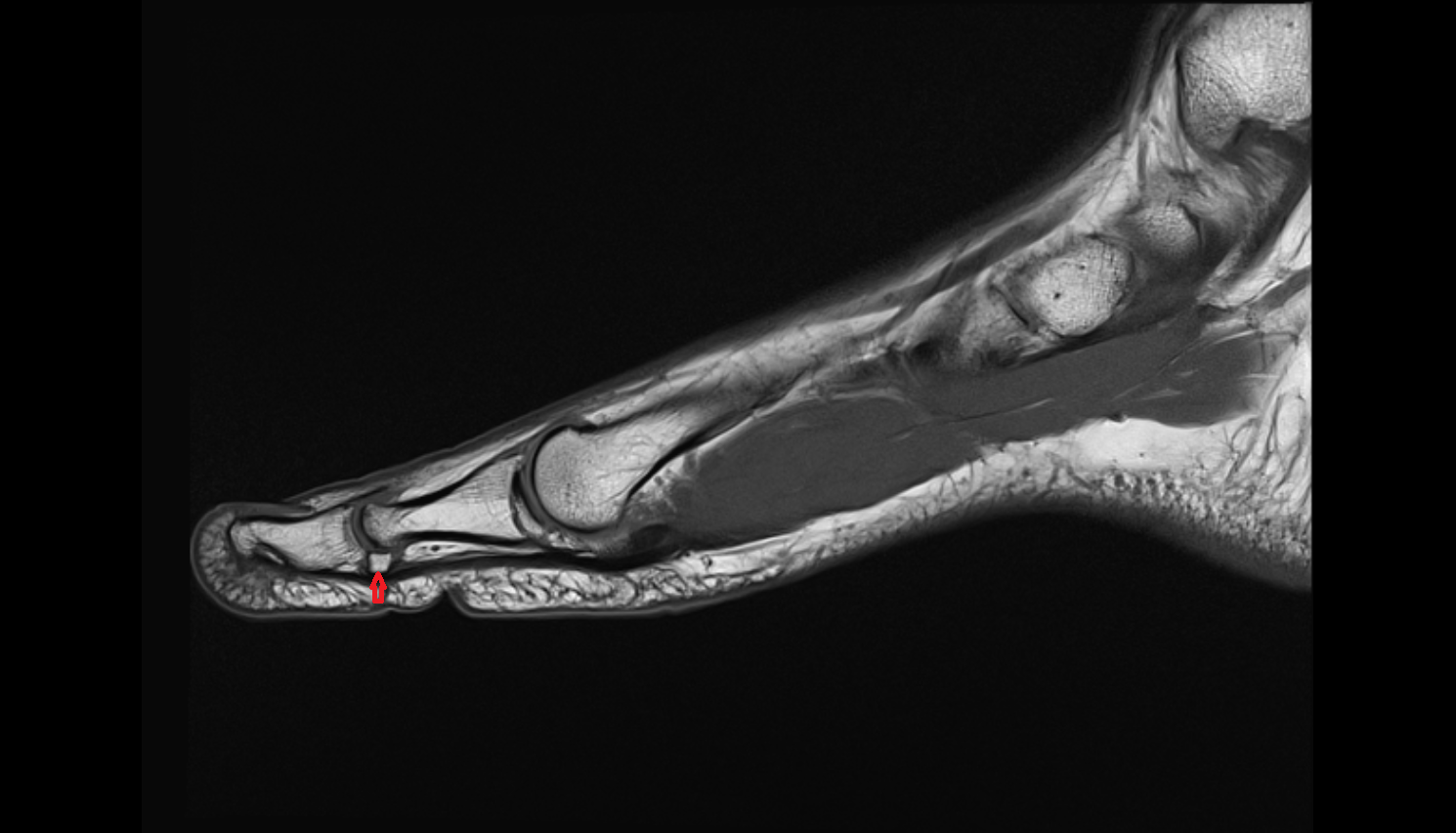 Interphalangeal sesamoid of great toe  mri  anatomy labelled image-img-00000-00000_00001
