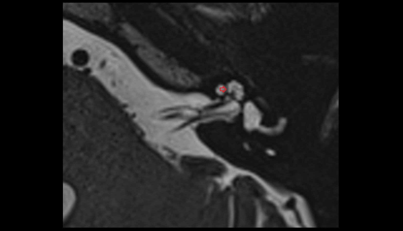 Interscalar septum mri axial image