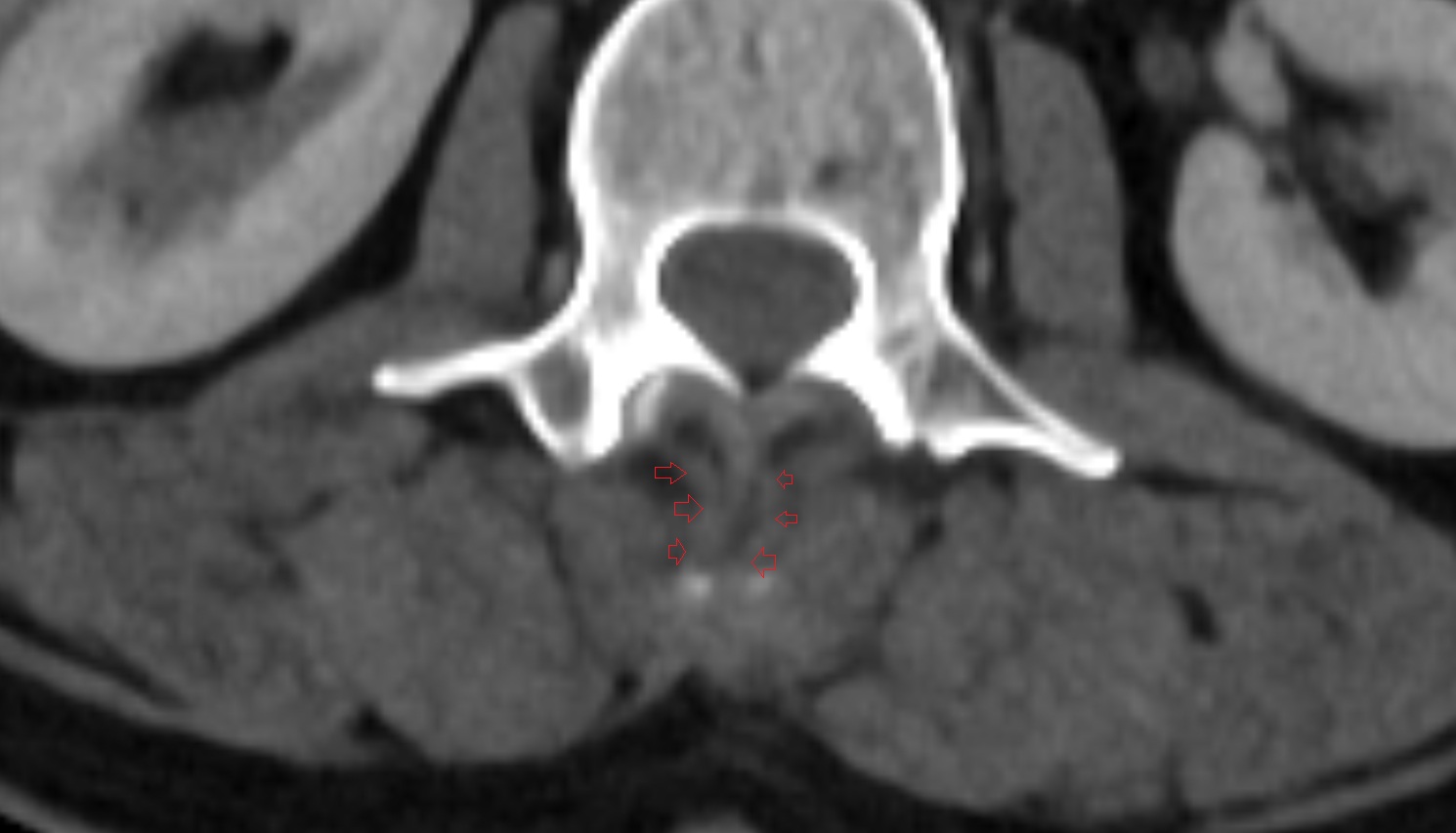 Interspinales lumborum muscle  CT axial  anatomy  image-img-00000-00000