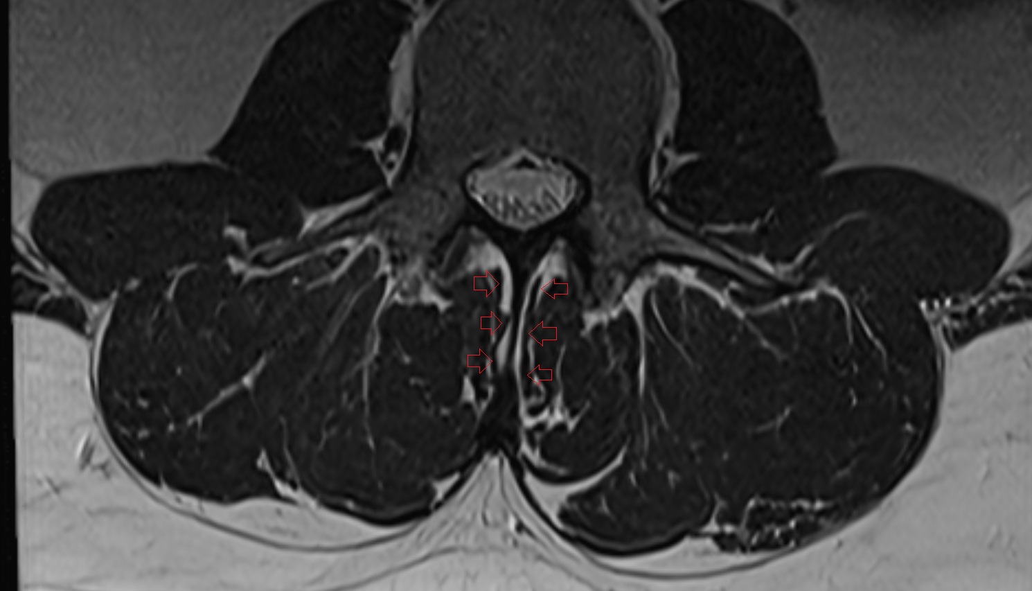 Interspinales lumborum muscle  MRI  axial  anatomy  image-img-00000-00000