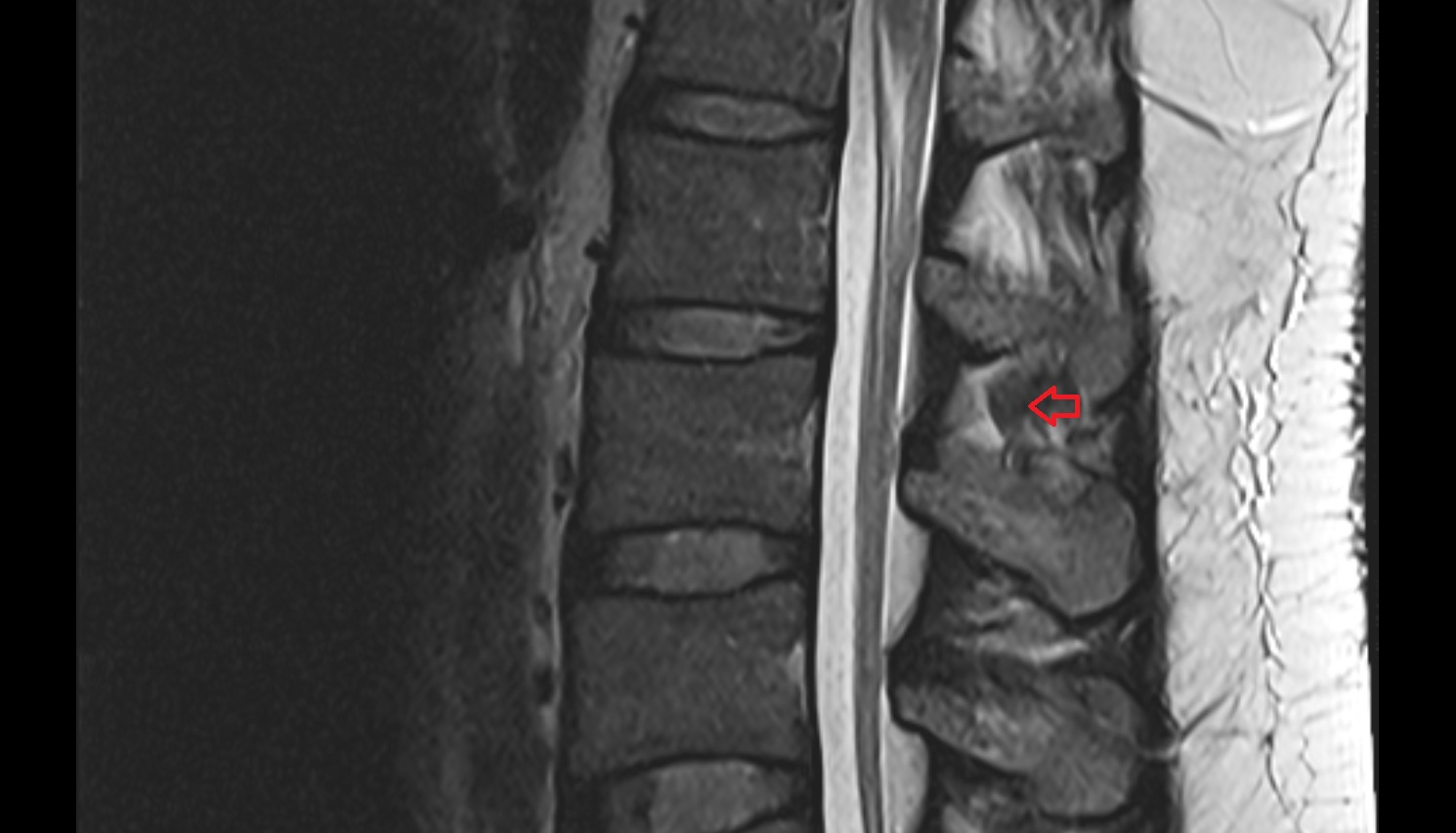 Interspinales lumborum muscle  MRI  sagittal  anatomy  image-img-00000-00000