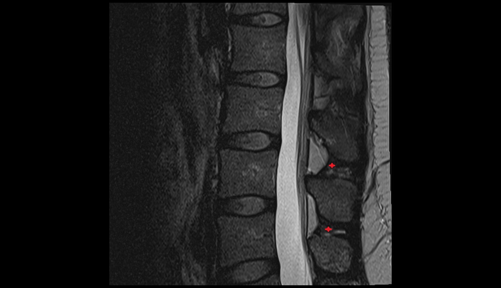 Interspinous ligamentm mri sag image